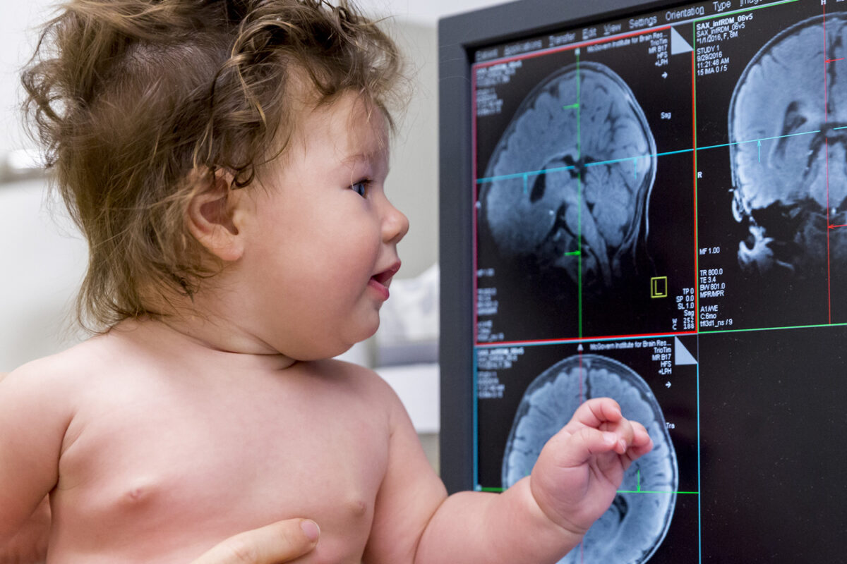 ÇOCUK ÇAĞI BEYİN TÜMÖRÜ 1